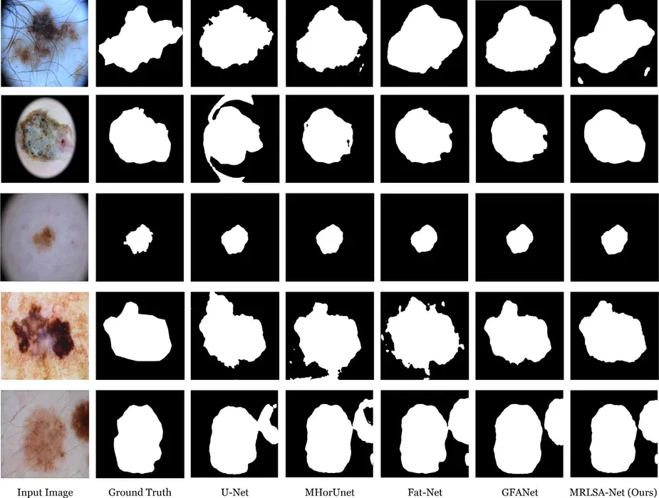 Figure 4 from “MRLSA-Net: An attention-enhanced framework for robust skin lesion segmentation”